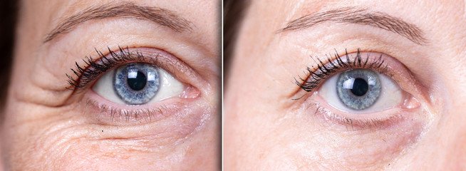 Você Sabia Que A Primeira Área Que Envelhece São As Dos Olhos? - imagem 4