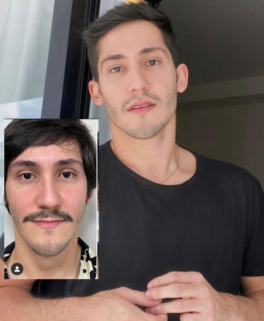 Exagero ou inchaço? Por que as selfies de famosos pós-harmonização facial sempre causam polêmica?