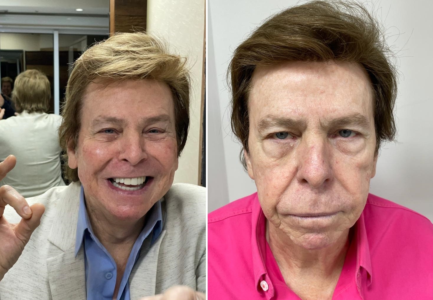 Especialista em harmonização facial de Nelson Rubens explica os efeitos do procedimento no rosto do