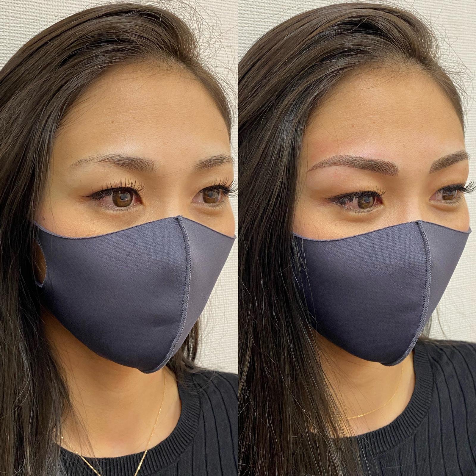 Microblanding gera resultados mais naturais nas sobrancelhas e contribui para harmonização facial - imagem 4