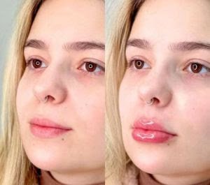 Tudo o que você precisa saber antes de preencher os lábios como a Viih Tube