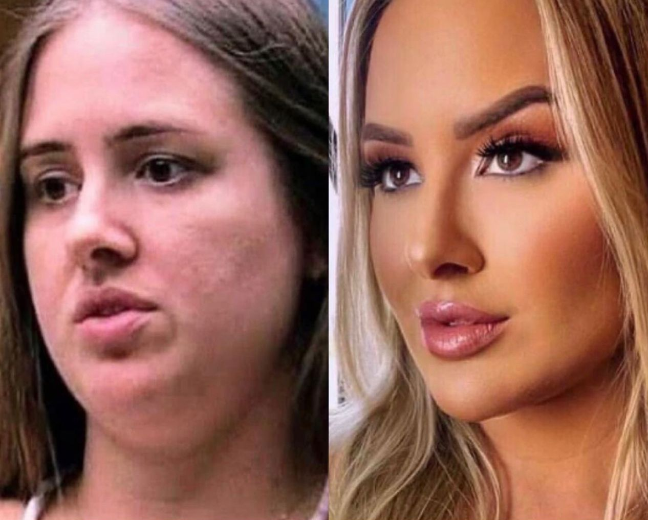 O mito da "desarmonização facial'': Por que tantos procedimentos dão errado?