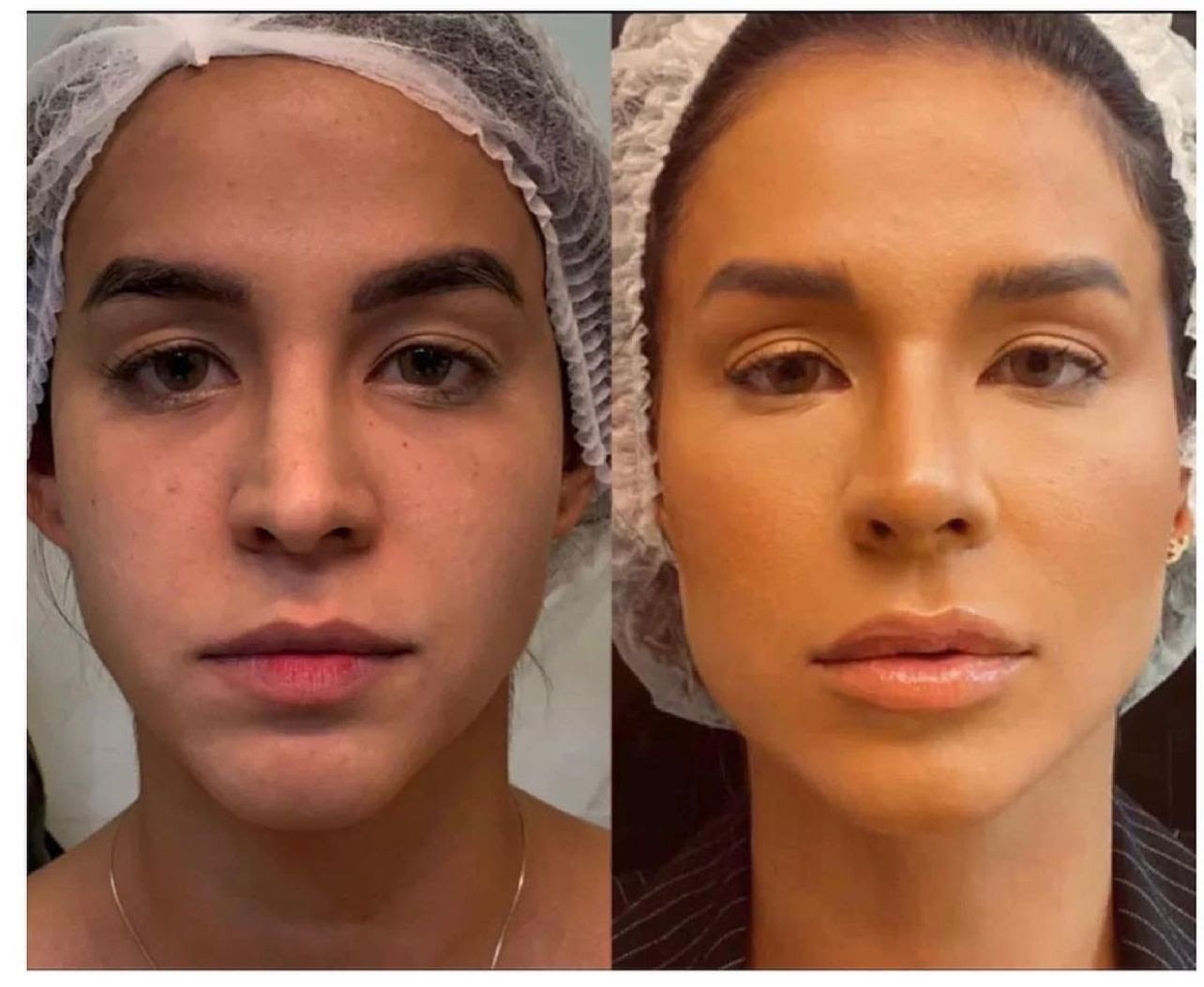 O mito da "desarmonização facial'': Por que tantos procedimentos dão errado? - imagem 5