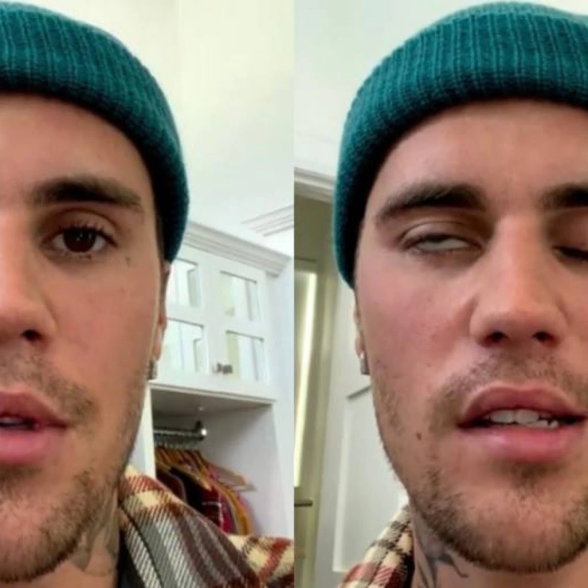 A importância de entender a síndrome de Ramsey-Hunt de Justin Bieber na perspectiva neurológica: qual a