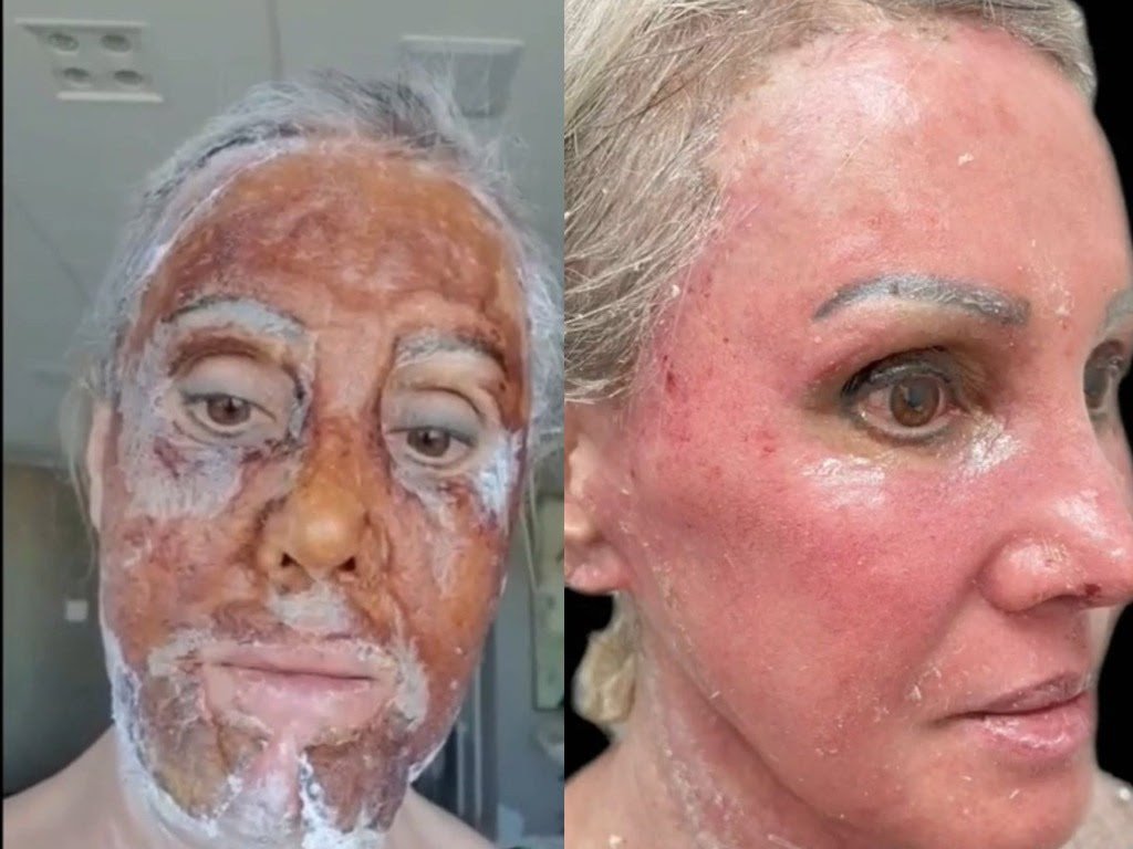 Peeling de fenol renova a pele,mas é preciso cautela - imagem 3