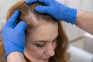 Calvície Feminina: um dos problemas capilares mais frequentes em mulheres - imagem 6